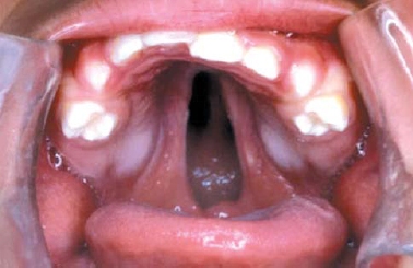 schisis pm